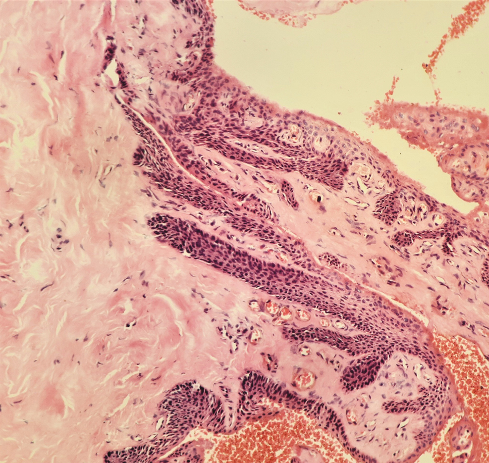 H&E showed both epithelial and stromal components. Epithelial strands originating from the nail matrix were seen to be penetrating vertically into the stroma, suggestive of an onychomatricoma (H&E 400×)