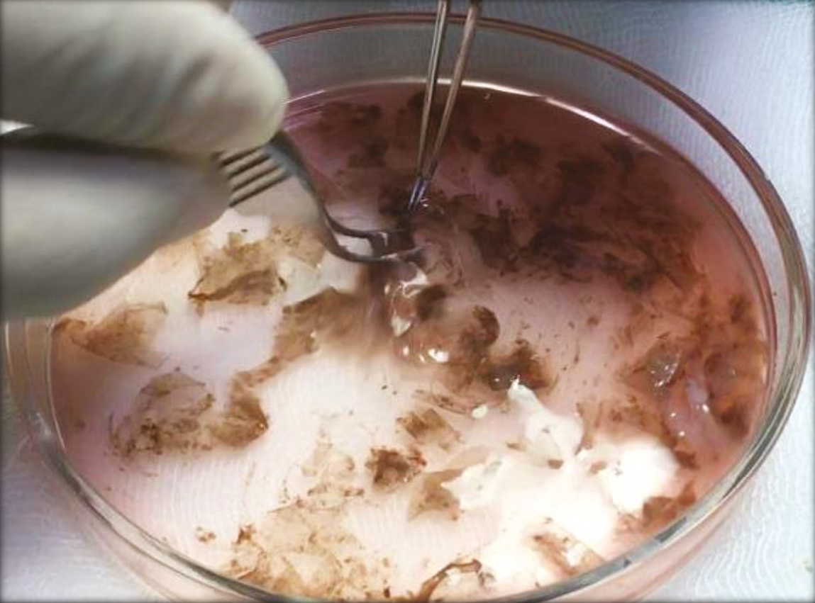 Graft is transferred to a petri dish containing Trypsin-EDTA and then incubated. The incubated specimen is then subjected vigorous agitation to separate epidermis and dermis