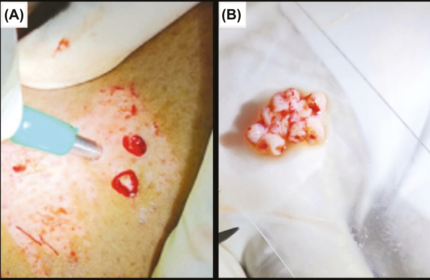 (A) Harvesting follicular dermal grafts with biopsy punch. (B) Follicular grafts obtained after smashing