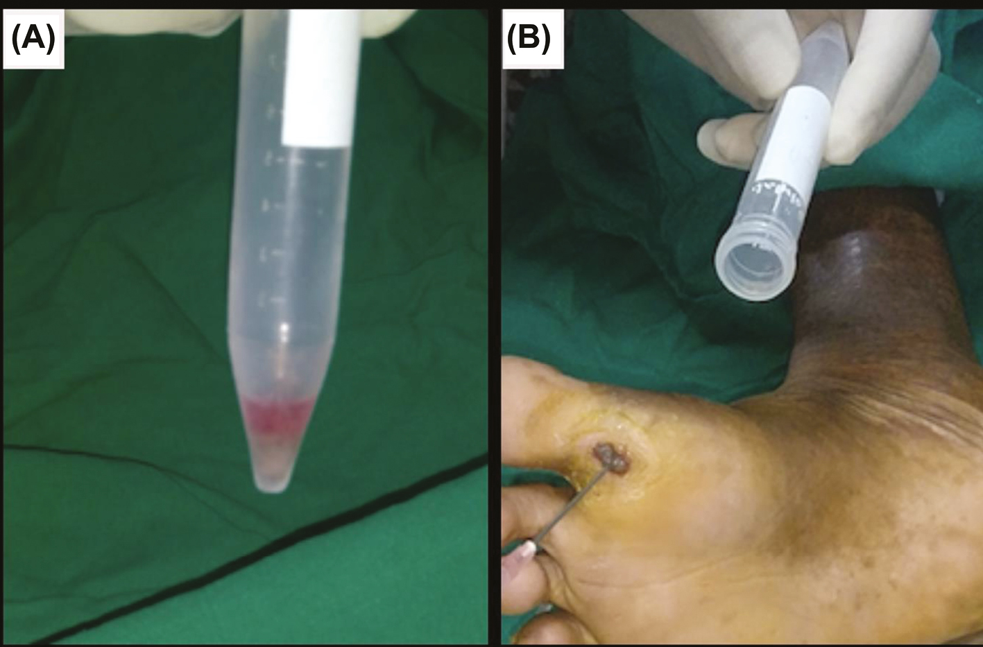 (A) Pellet thus obtained after centrifugation. (B) Application of smashed follicular dermal graft and ECS mixture to the ulcer bed