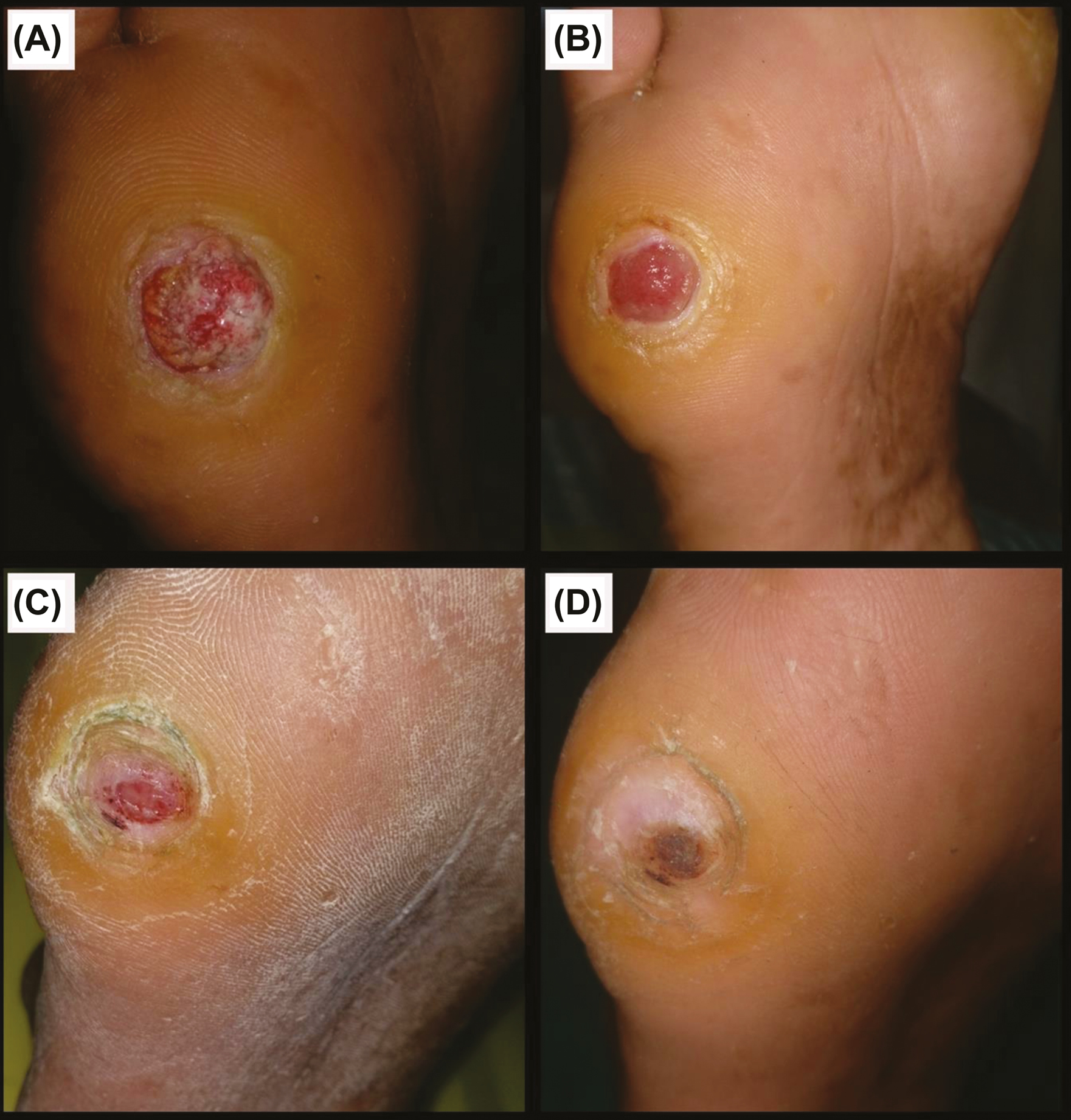 Group A: (A) Before procedure. (B) 1 week post-procedure. (C) 3 weeks post-procedure. (D) 5 weeks post-procedure