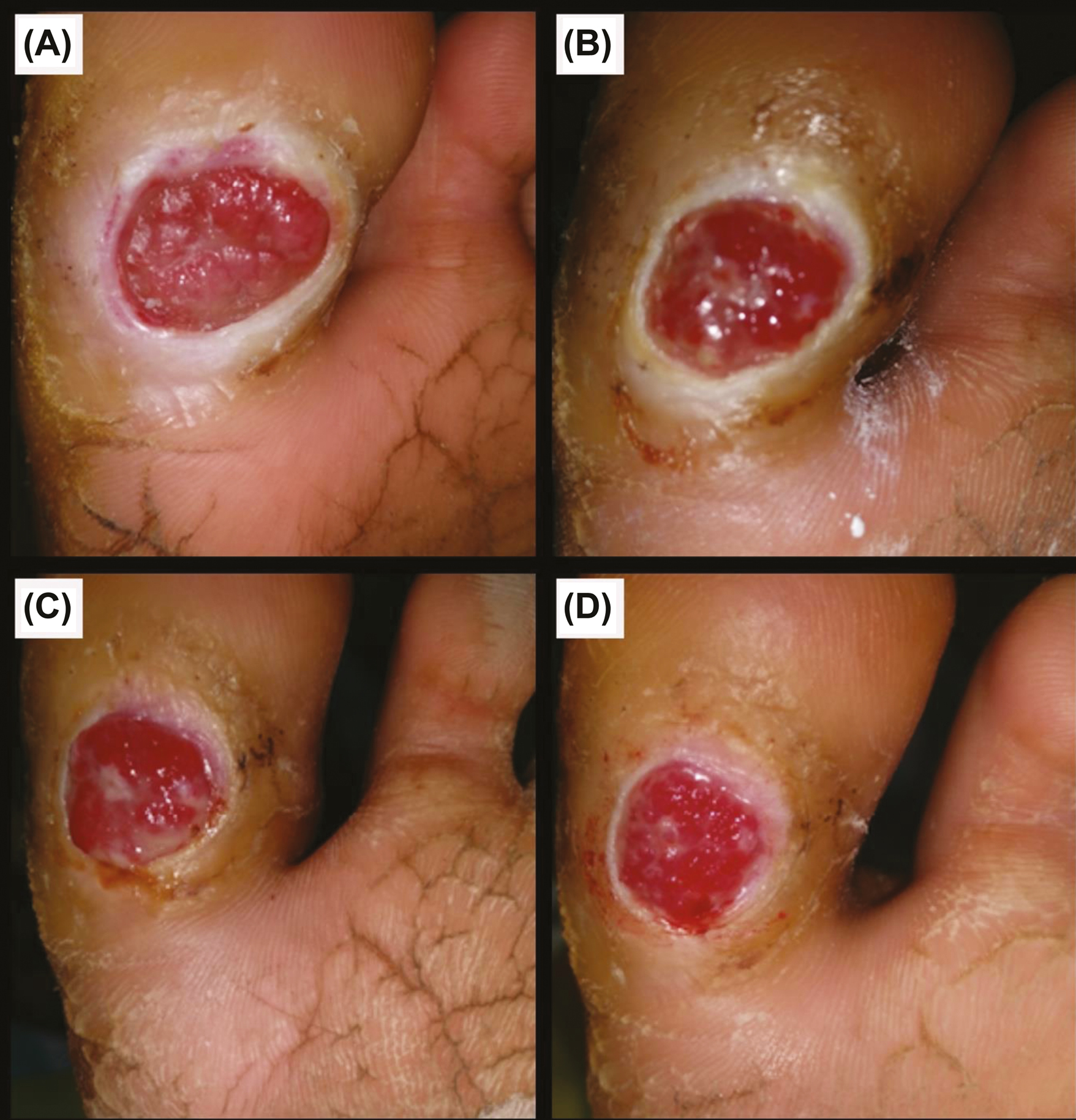 Group B: (A) Before procedure. (B) 1 week post-procedure. (C) 12 weeks post-procedure. (D) 6 months post-procedure