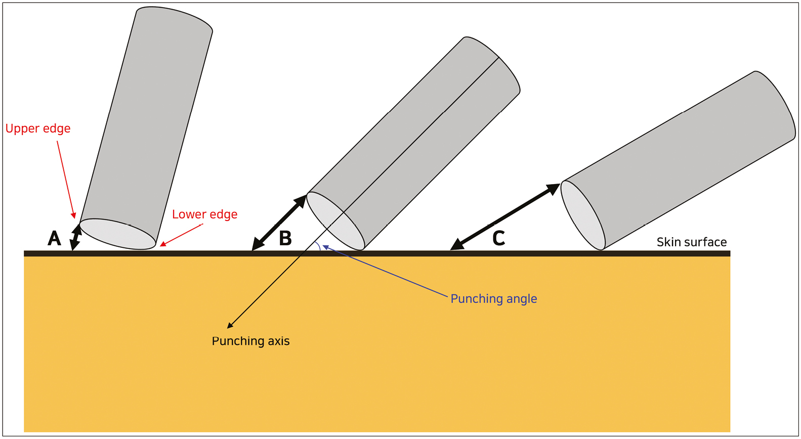 The lower and upper edges of the punch contact the skin at different times according to the punching angle