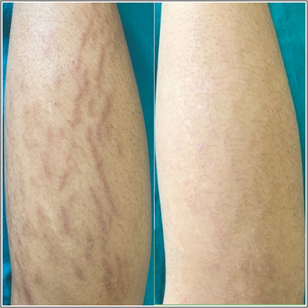 Striae over left posterior leg: before and after treatment with fractional CO2 laser and PRP, showing grade 4 improvement