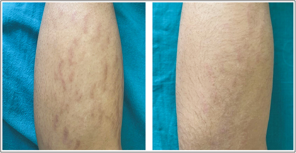 Striae over right posterior leg: before and after treatment with fractional CO2 laser alone, showing grade 4