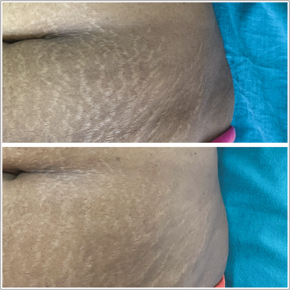 Striae over left abdomen: before and after treatment with fractional CO2 laser and PRP, showing grade 3 improvement