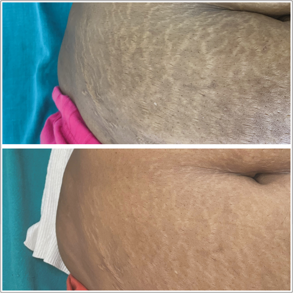 Striae over right abdomen: before and after treatment with fractional CO2 laser alone, showing grade 3 improvement