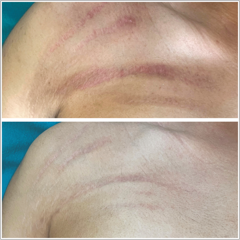 Striae over right shoulder: before and after treatment with fractional CO2 laser and PRP, showing grade 3 improvement