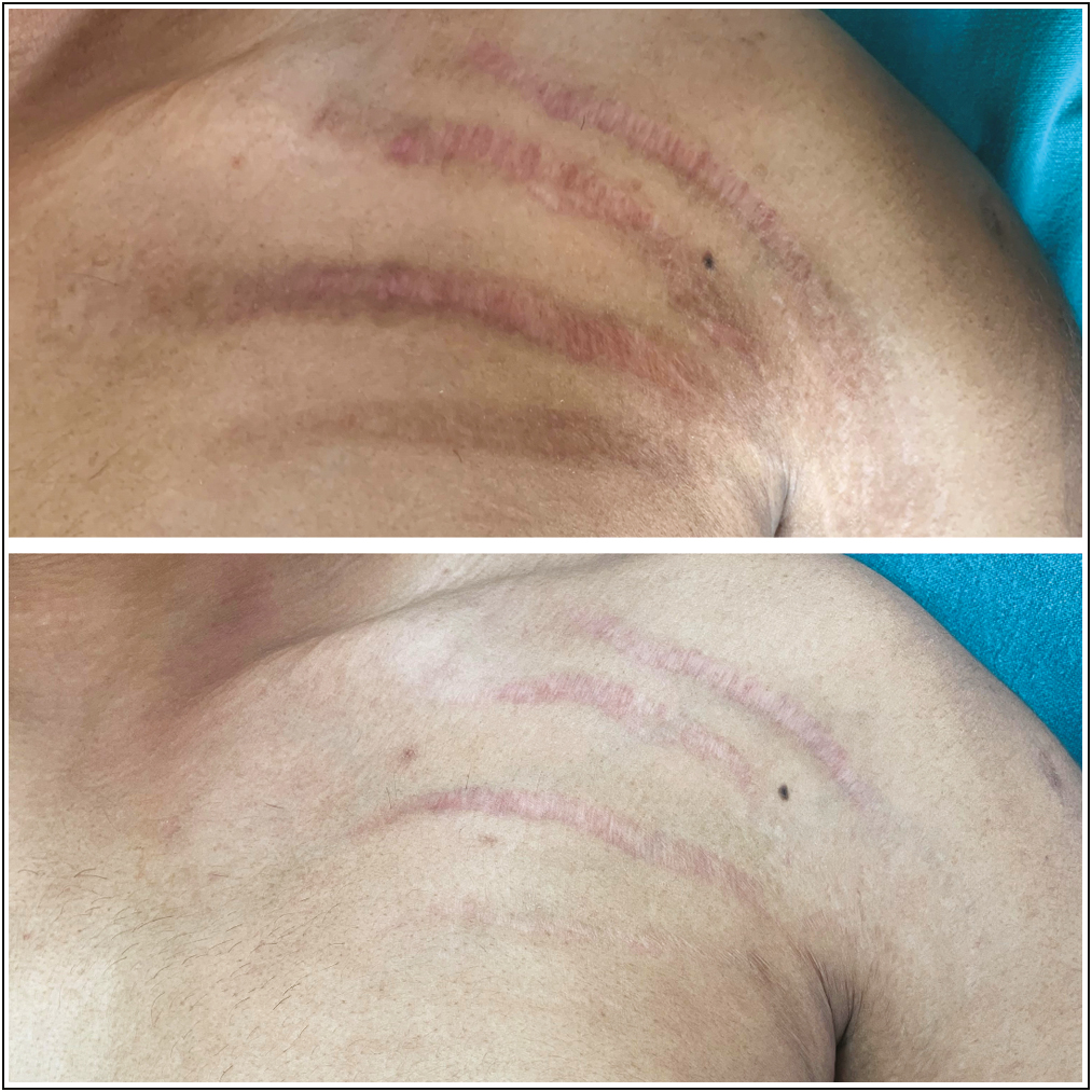 Striae over left shoulder: before and after treatment with fractional CO2 laser alone, showing grade 3 improvement