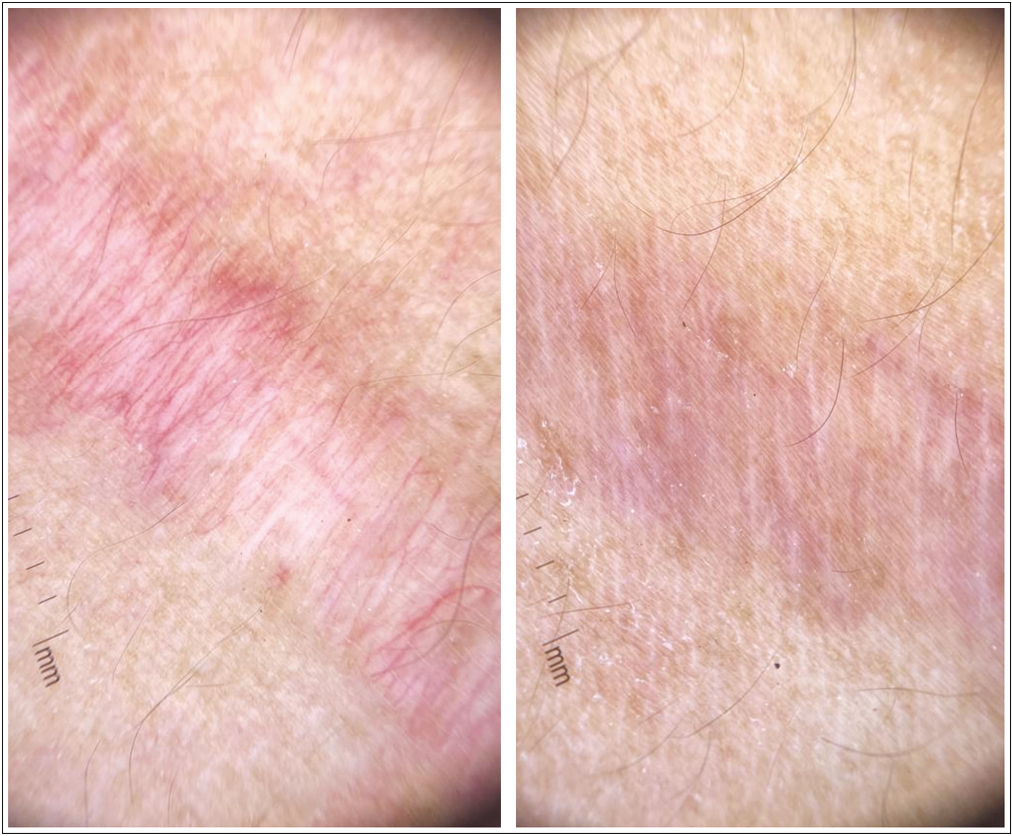 Dermoscopy of striae rubra: before and after treatment with fractional CO2 laser and PRP; the resolution of linear vessels arranged both along and perpendicular to the long axis of the striae before treatment have resolved with decreased atrophy