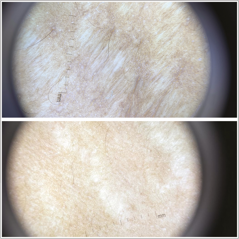 Dermoscopy of striae alba: before and after treatment with fractional CO2 laser and PRP, showing the decrease in width, wrinkling and hypopigmentation of the striae