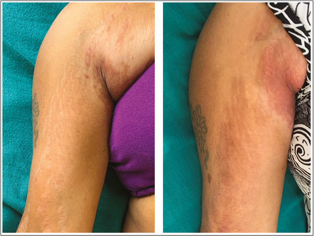 Striae over right arm: before and after treatment with fractional CO2 laser alone, showing grade 2 improvement and hyperpigmentation