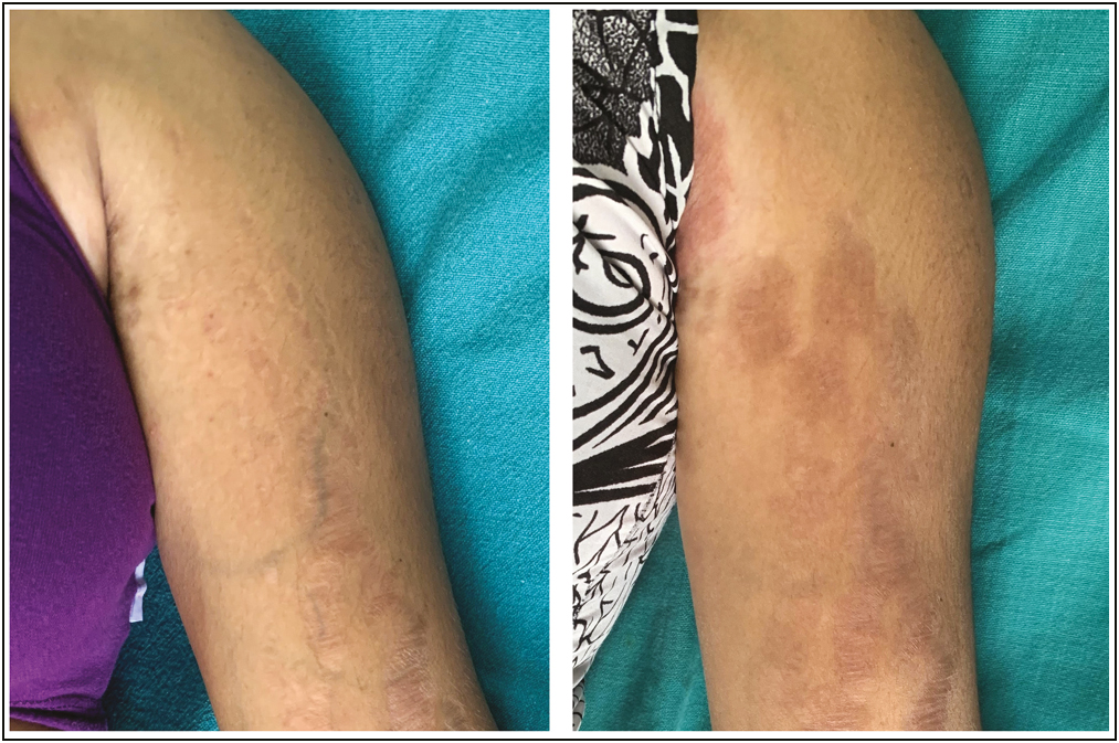 Striae over left arm: before and after treatment with fractional CO2 laser and PRP, showing grade 2 improvement and hyperpigmentation