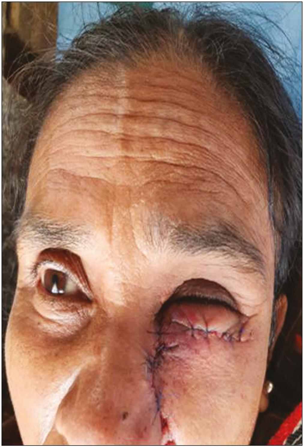 Edema of eyelid obstructing the vision