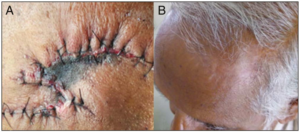 (A) Tip necrosis in double rotational flap due to acute angle of rotation. (B) Very well healed scar following superficial tip skin necrosis