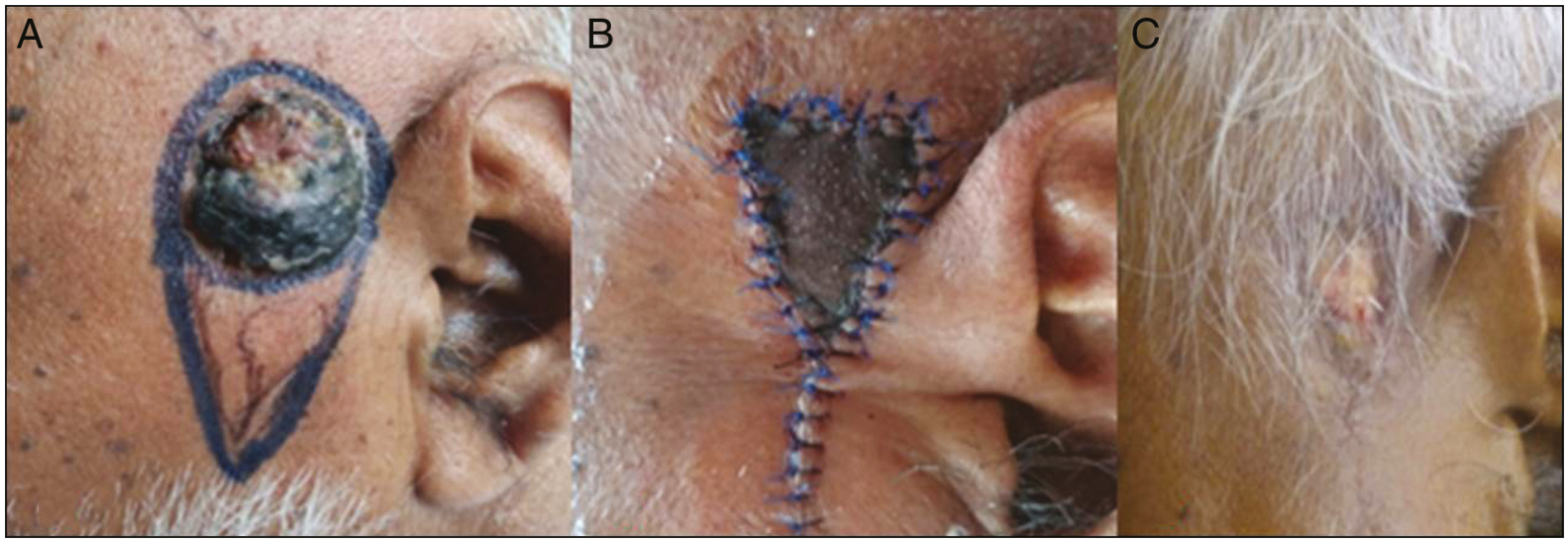 (A–C) Full-thickness flap necrosis healed with secondary intention