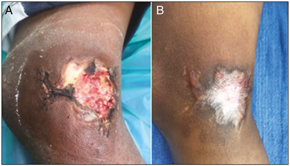 (A and B) Full-thickness flap necrosis healing with hypertrophic unacceptable scar