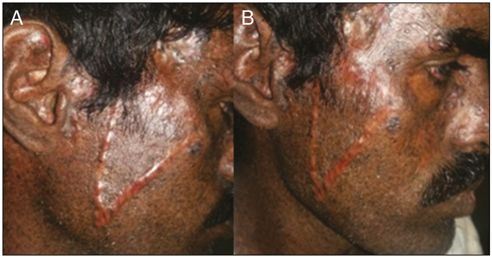 (A and B) Hypertrophic scar managed with three sittings of intralesional steroid