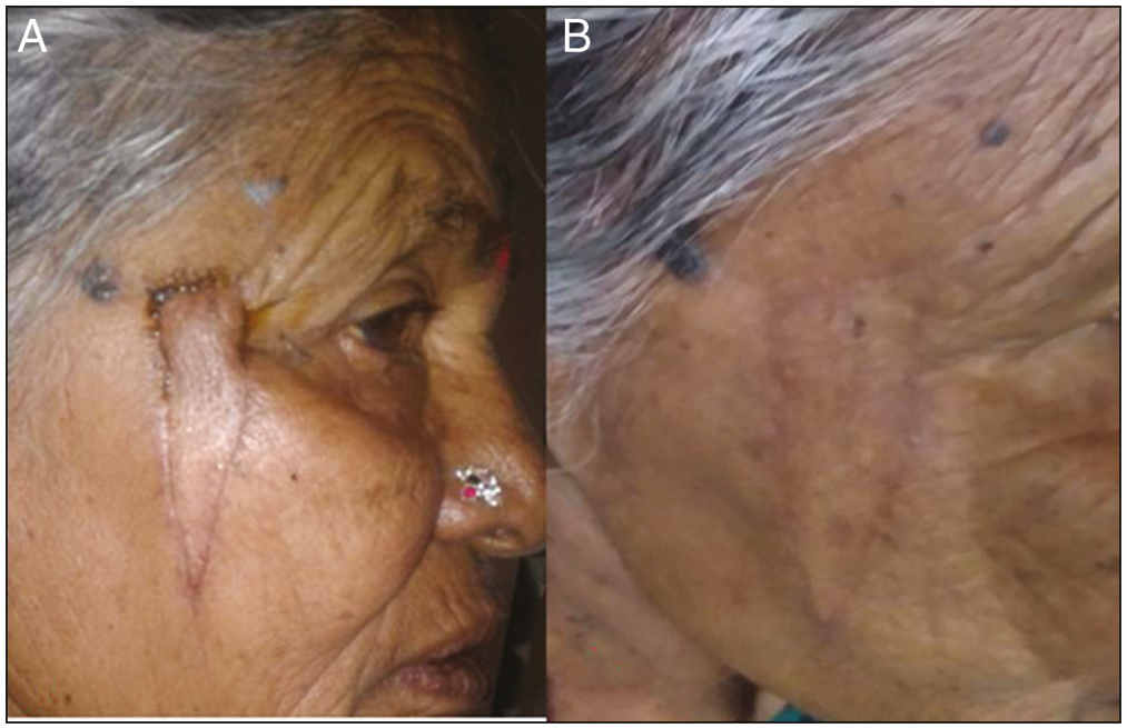 (A and B) Pin cushion deformity managed wih intralesional steroid