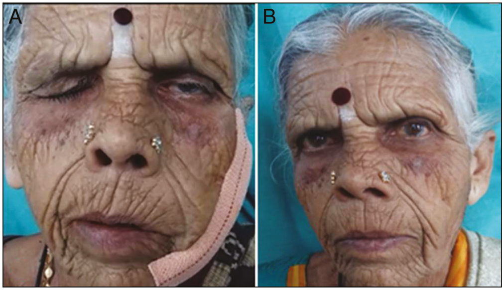 (A and B) Temporary facial nerve palsy with spontaneous recovery