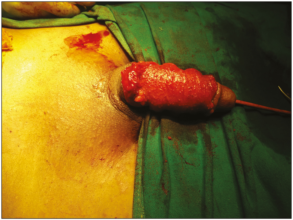 Dermofat graft attached to penis