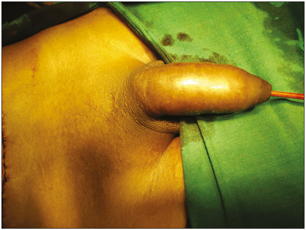 Appearance at the end of surgery with penile skin replaced back to its original position