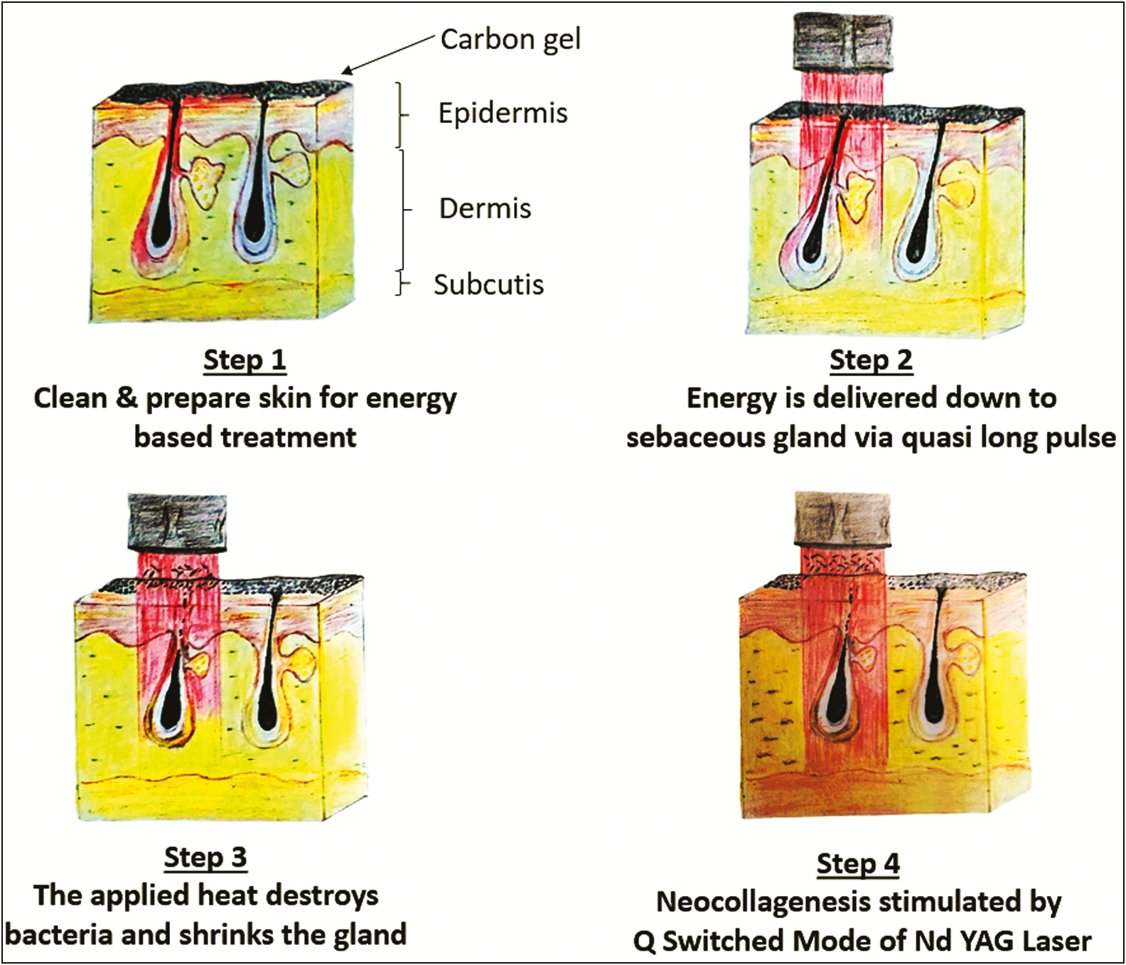 Diagrammatic representation of the mechanism of action of carbon peel