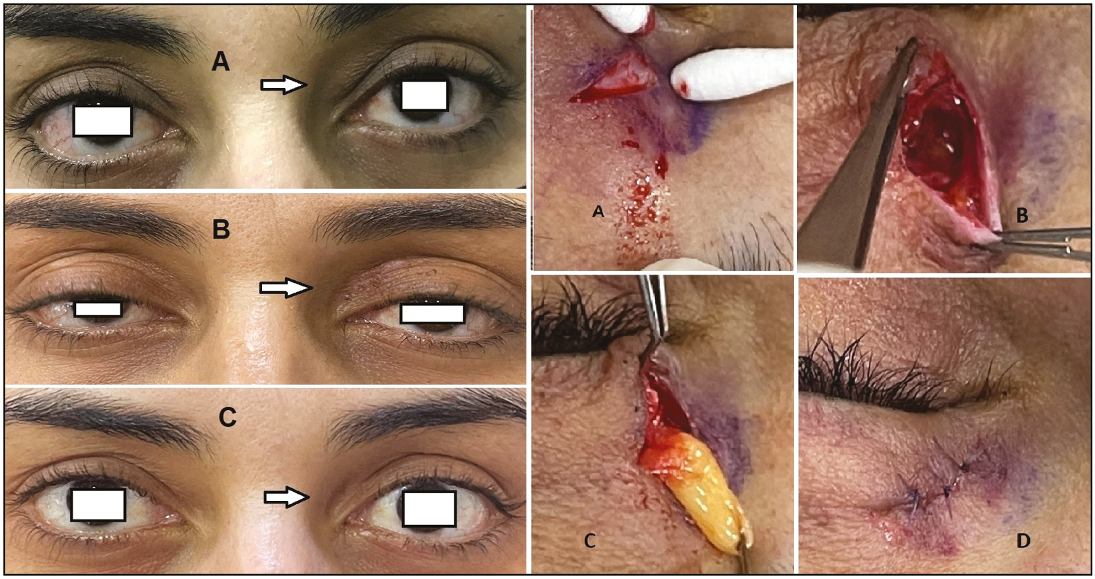 Left: (A) baseline photograph of the left eye with nasal fat pad bulge, (B) 6-month post-operative photograph, and (C) 2-year follow-up photograph. Right: surgical technique: (A) small incision 4 mm in the nasal eyelid crease, (B) blunt dissection of orbicularis muscle toward nasal fat pad, (C) nasal fat pad isolation and excision, and (D) wound closure