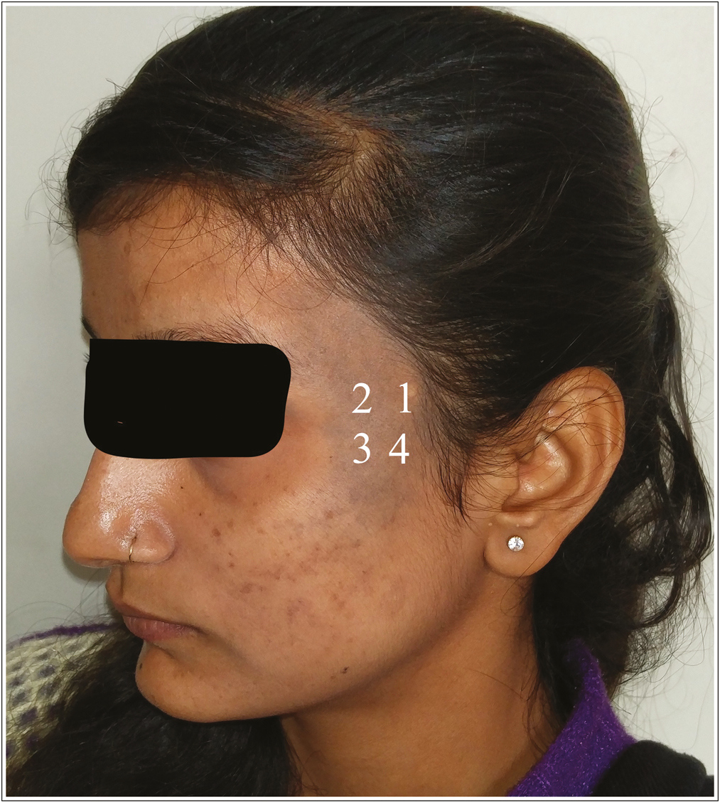 Points taken to perform dermoscopy. First point around biopsy side, second point is 2 cm medial (or lateral) to biopsy site, third point is 2 cm below the second point, fourth is 2 cm below first point