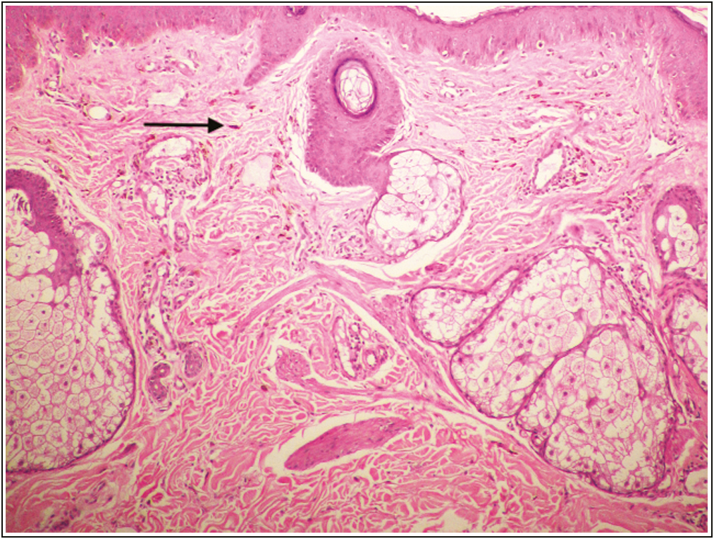 Histopathology showed bipolar melanocytes (arrow) distributed in between collagen bundles in superficial reticular dermis. 100×