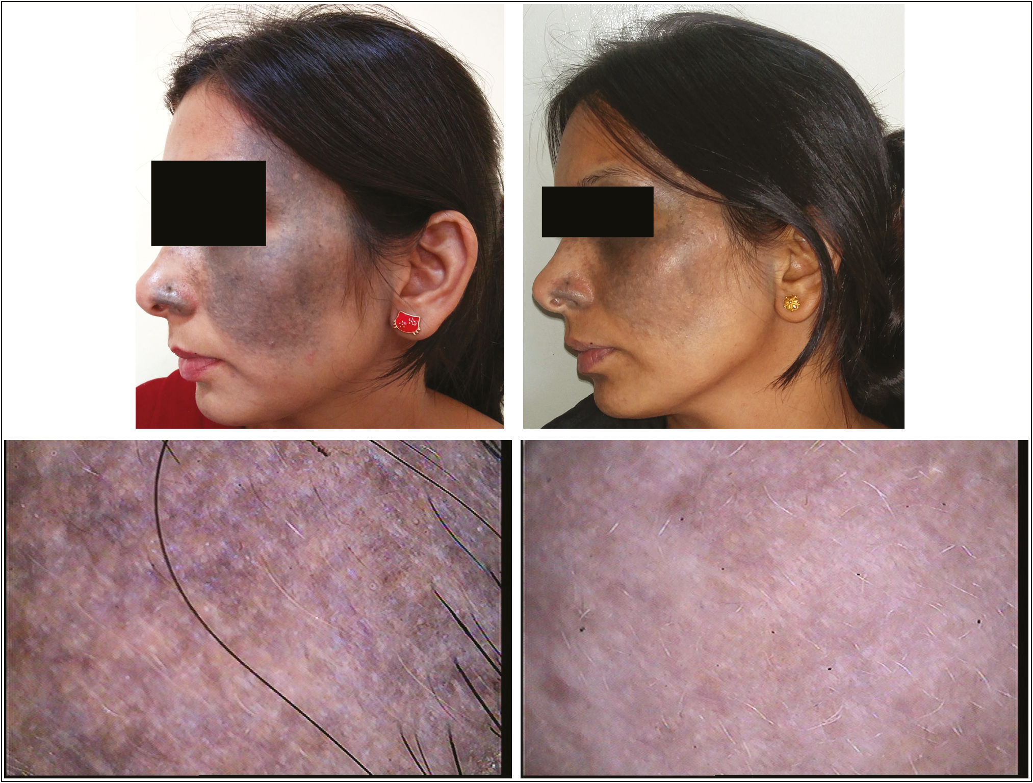 Pretreatment (A) and posttreatment (B) photographs of group 2 patient showing PGA grade 3 (>50%) improvement. Pre-dermoscopy (C) and post-dermoscopy (D) images of same patient showing grade 3 improvement on dermoscopy after six sessions