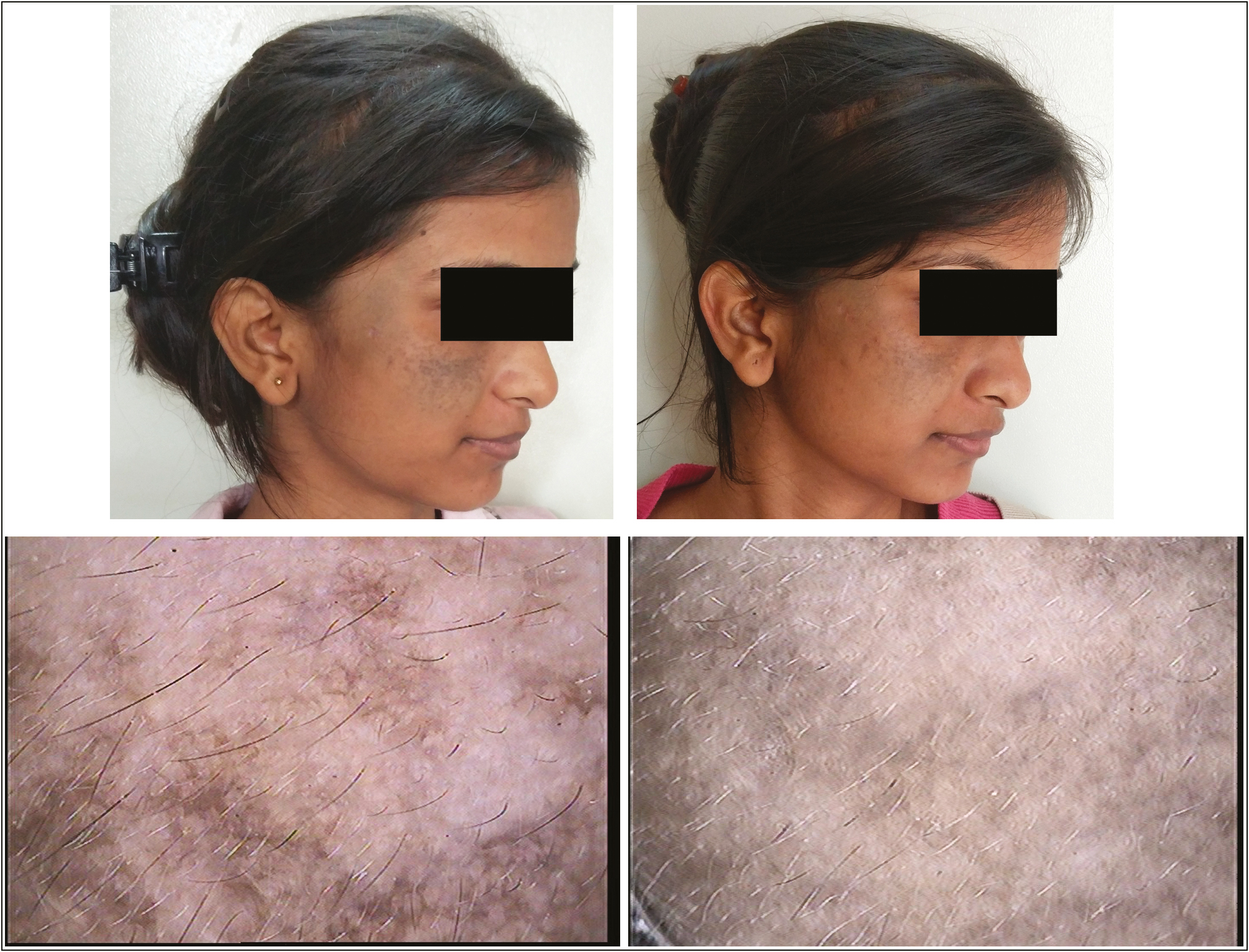 Pretreatment (A) and posttreatment (B) photographs of group 1 patient showing PGA grade 1 improvement. Pre-dermoscopy (C) and post-dermoscopy (D) images of same patient showing grade 1 improvement on dermoscopy after six sessions