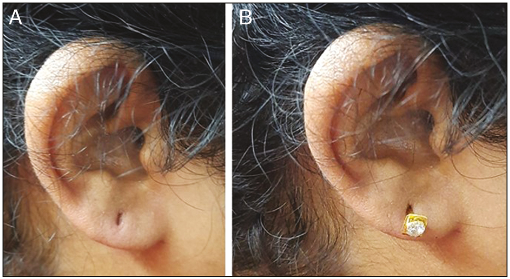 (A) Type 1 incomplete cleft ear lobe. (B) Ear stud dangling from the ear hole