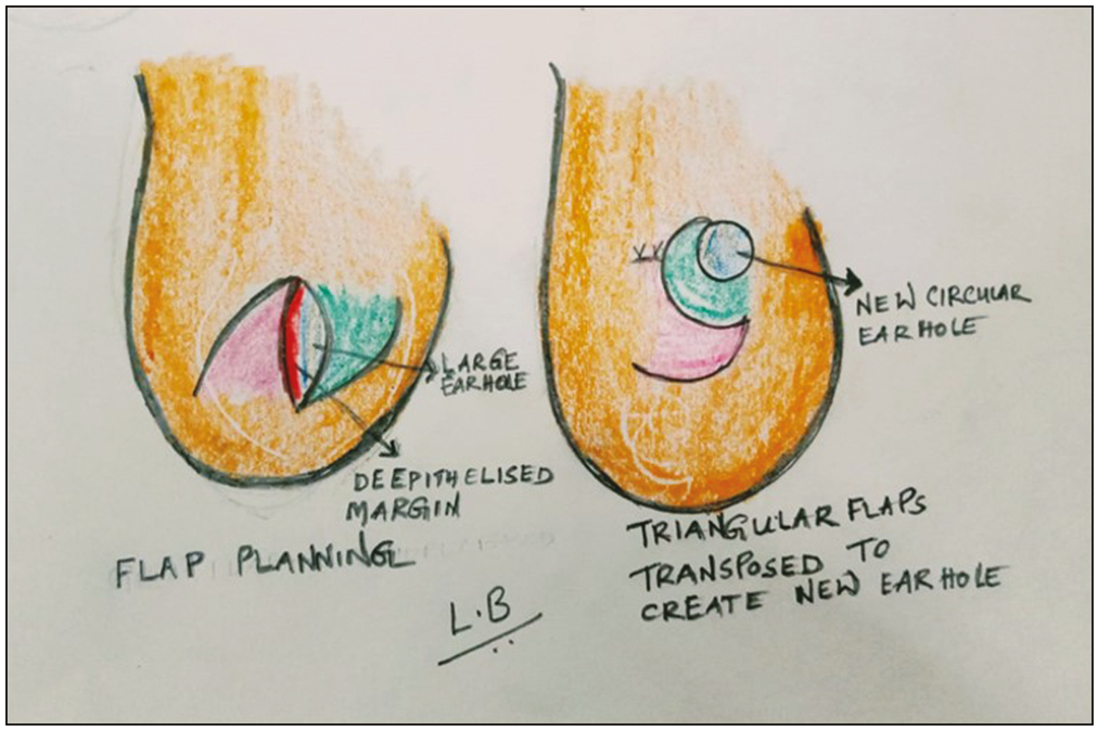 Schematic diagram showing the flap design and final appearance of ear lobe