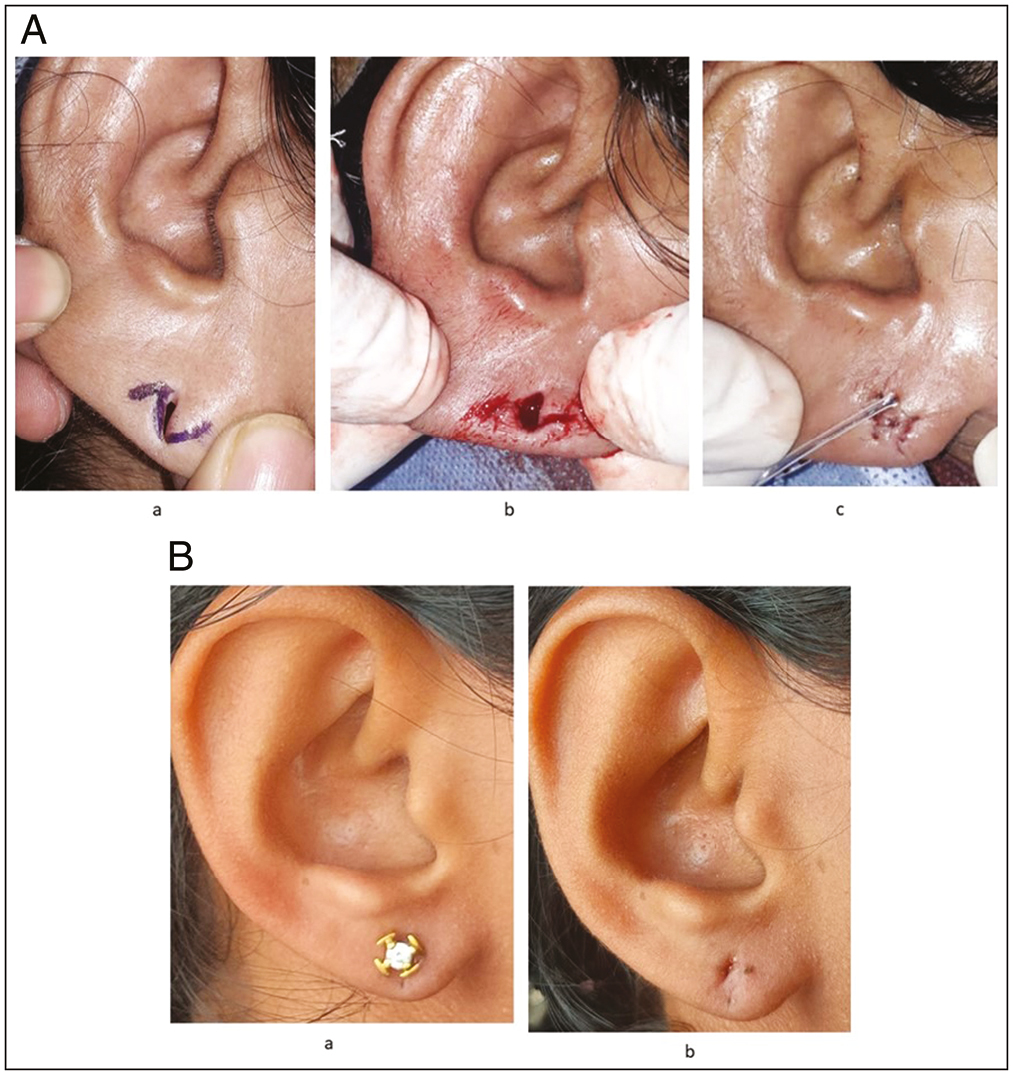 (A) Representative Case 1: (a) flap design, (b) flaps raised, and (c) after flap inset with spacer. (B) Postoperative results of representative Case 1: (a) with ear stud and (b) without ear stud