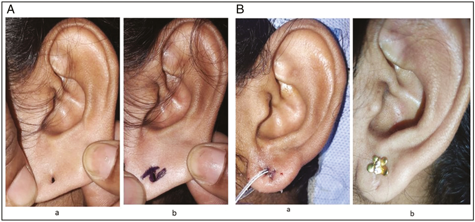 (A) Representative case 2: (a) large ear hole and (b) flap markings. (B) Postoperative results: (a) immediate postoperative picture and (b) late postoperative picture with stud