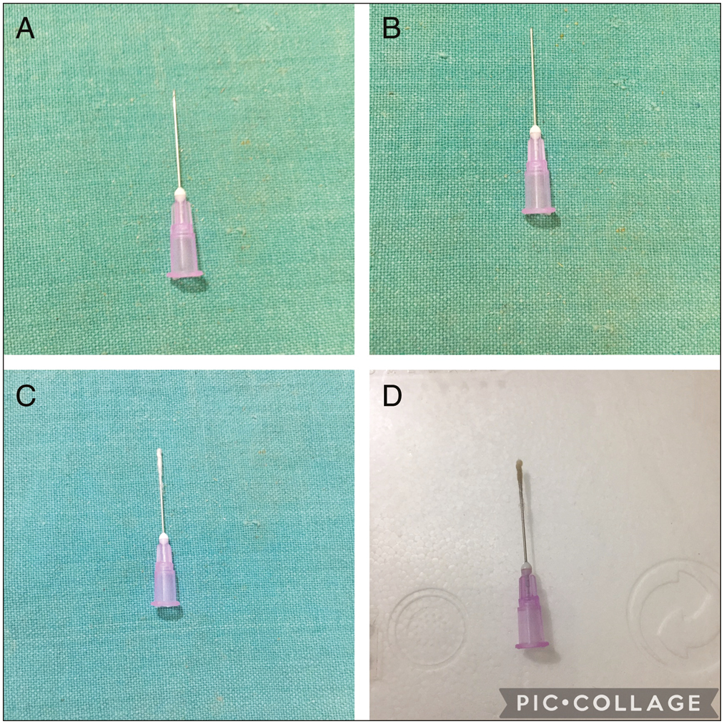 (A)–(D) Hypodermic needle is customized into mini cotton ball applicator for chemical cautery