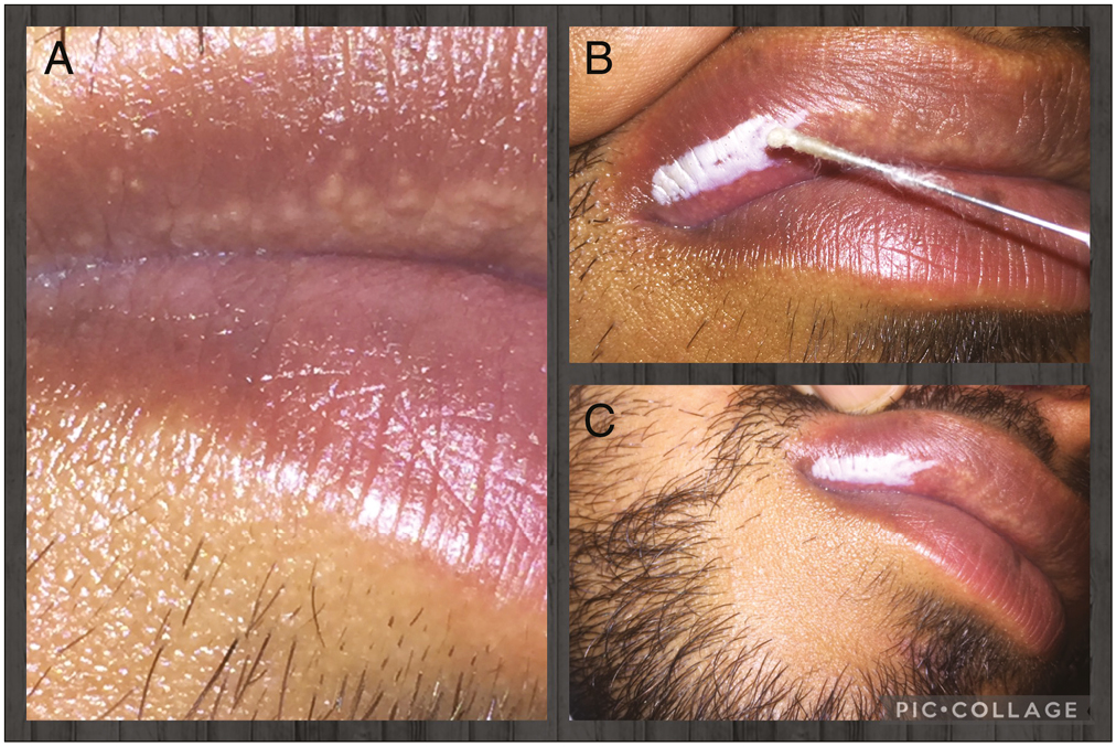 (A)–(C) Fordyce spots are cauterized with hypodermic needle cotton bud