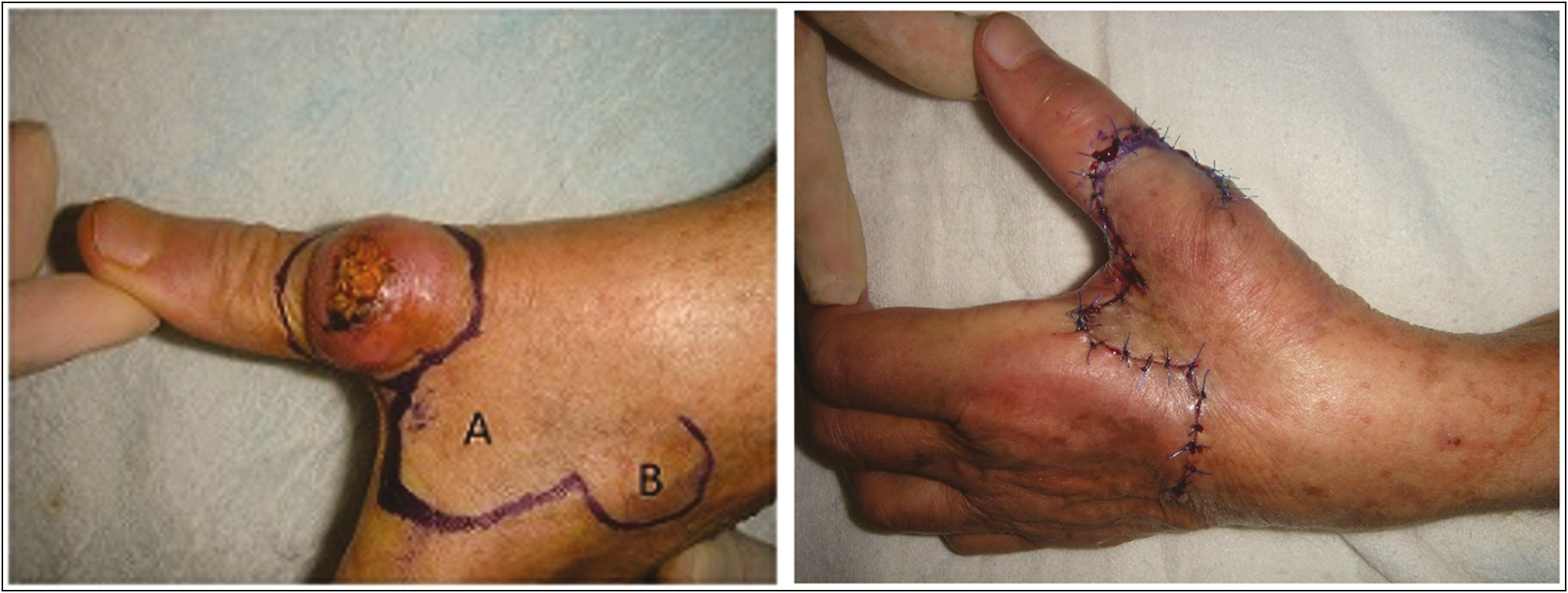 Bilobed flap for reconstruction of a large keratoacanthoma of the thumb