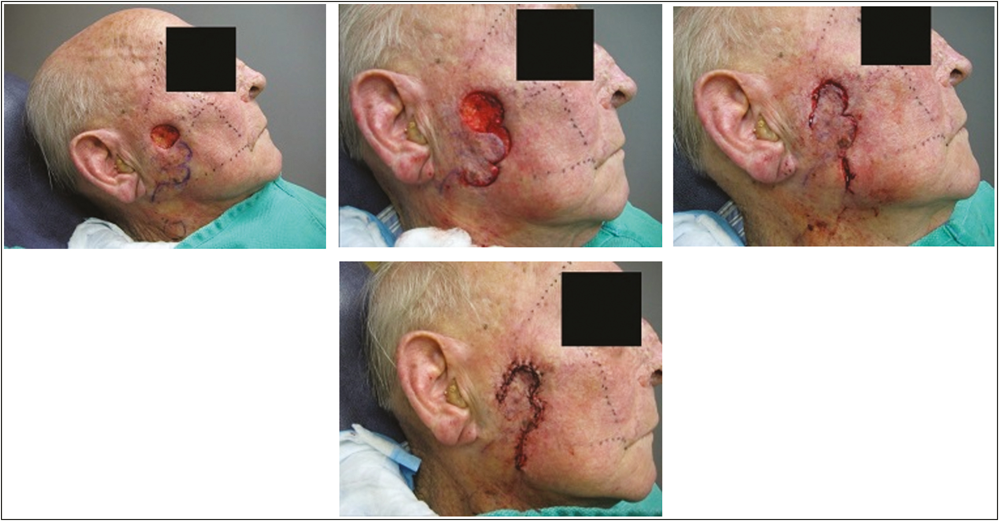 The usefulness of the bilobed flap for lateral cheek defects[5]