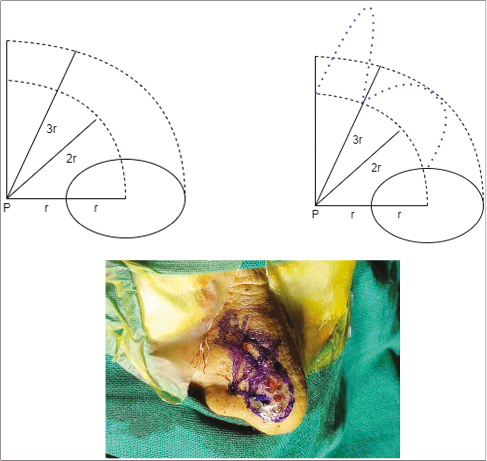 Showing concentric arcs in which the flaps will lie