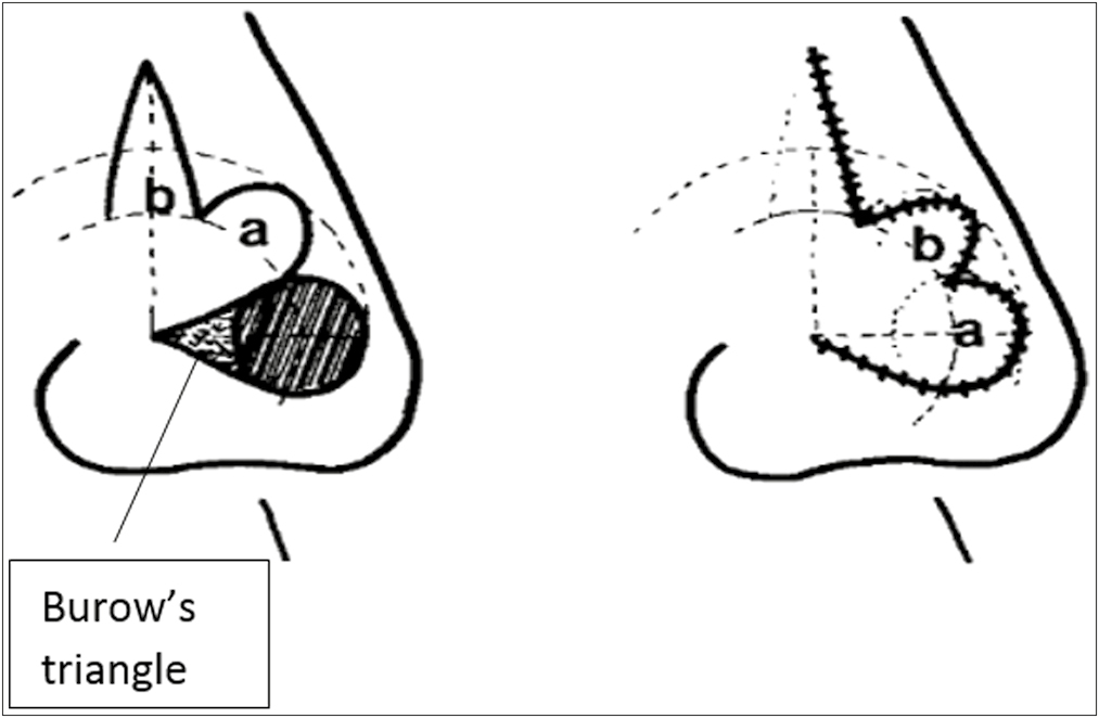 Showing improved design with minimum chance of dog ear formation[9]