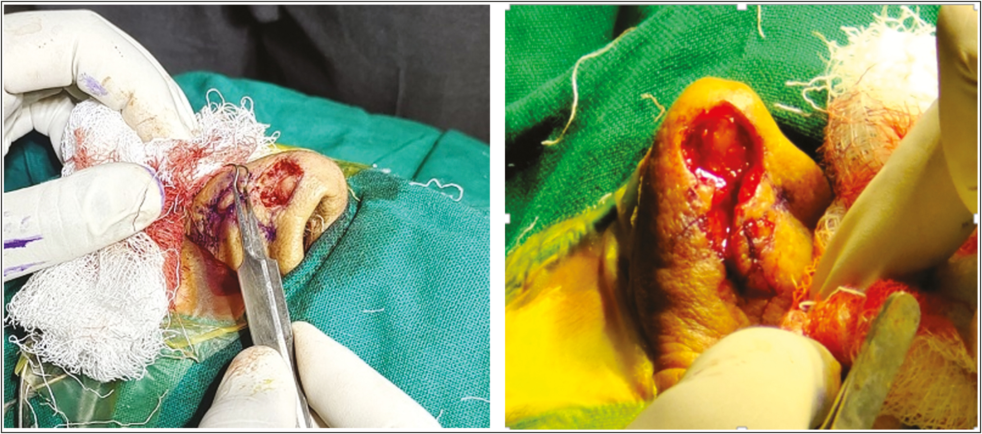 Showing excision of the defect up to the level of perichondrium