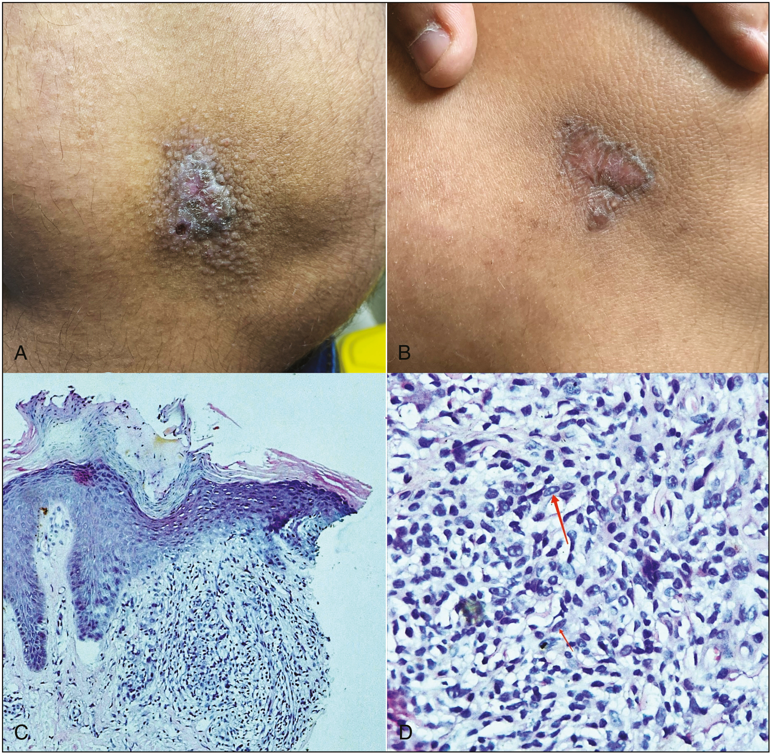 (A) Solitary, 2 cm x 1 cm, reddish-brown plaque with minimal scaling over medial aspect of left knee surrounded by skin colored micropapules. (B) Erythematous, atrophic plaque with hyperpigmented margins after 4 weeks of treatment. (C) Mild acanthosis and elongation of rete ridges, superficial dermis shows multiple well-formed epitheloid granulomas with surrounding lymphocytes (hematoxylin and eosin, 100x). (D) Well-formed epitheloid granulomas with surrounding lymphocytes (hematoxylin and eosin, 400x)