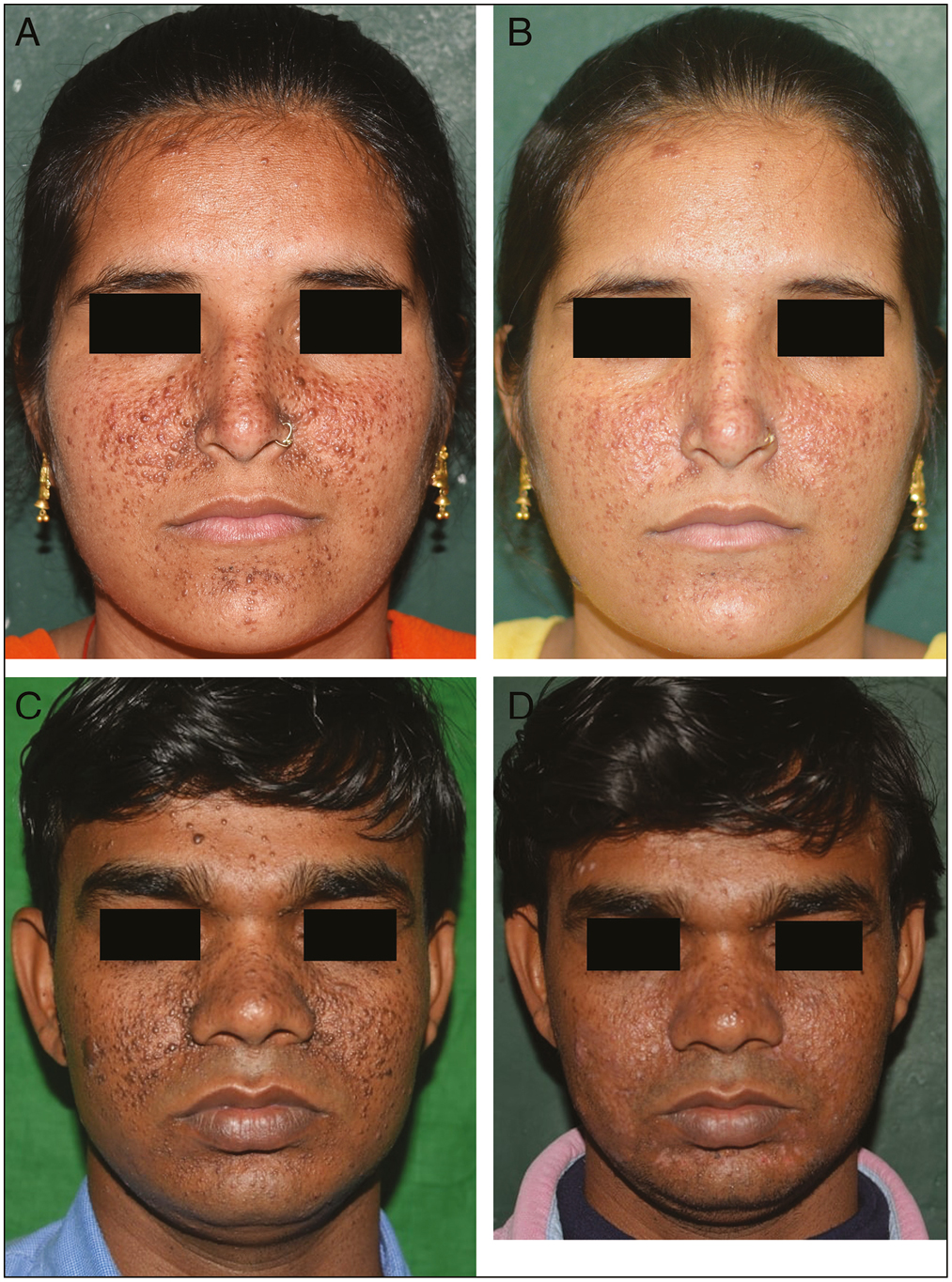 Improvement in facial angiofibromas: (A) and (C) at baseline; (B) and (D) after carbon dioxide laser (right cheek) and radiofrequency ablation (left cheek) after three sessions