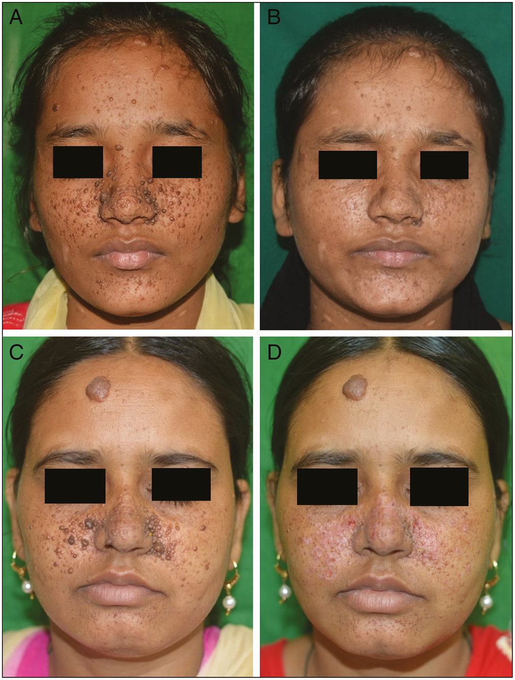 Improvement in facial angiofibromas; (A) and (C) at baseline; (B) and (D) after carbon dioxide laser (left cheek) and radiofrequency ablation (right cheek) after two sessions