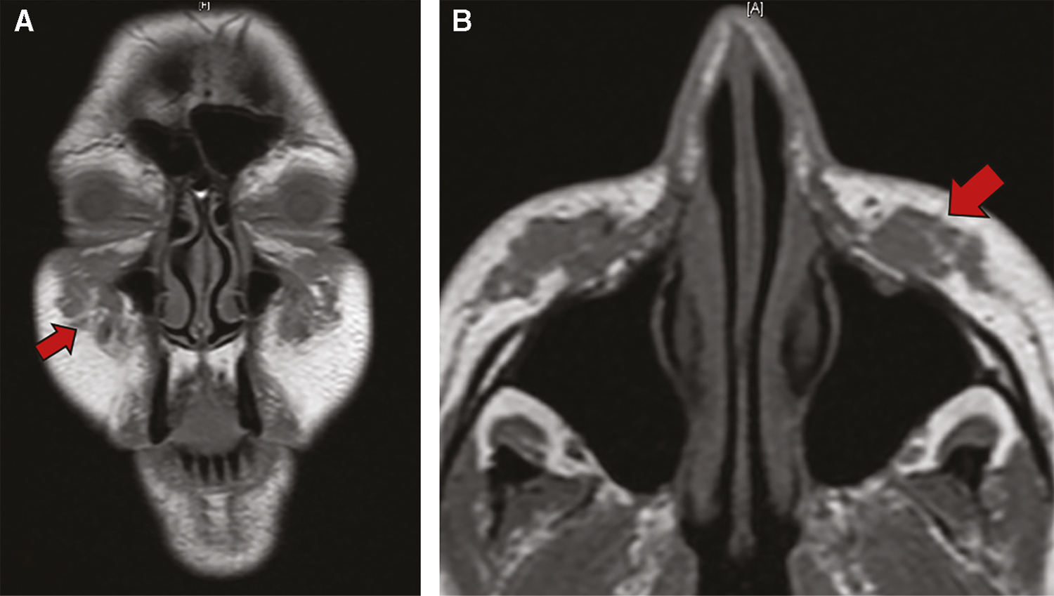 Pretreatment non-contrasted MRI T1 coronal (A) and axial (B)