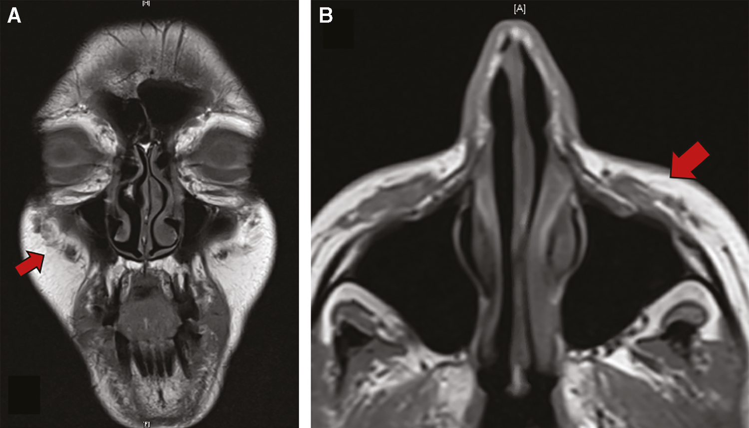 Posttreatment non-contrasted MRI T1 coronal (A) and axial (B)