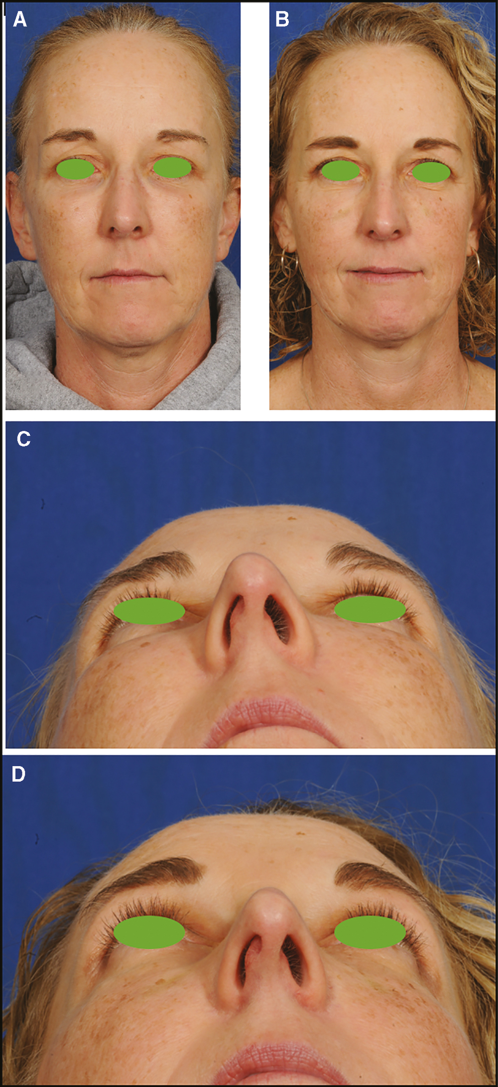 Pretreatment (A, C) and posttreatment (B, D) photos