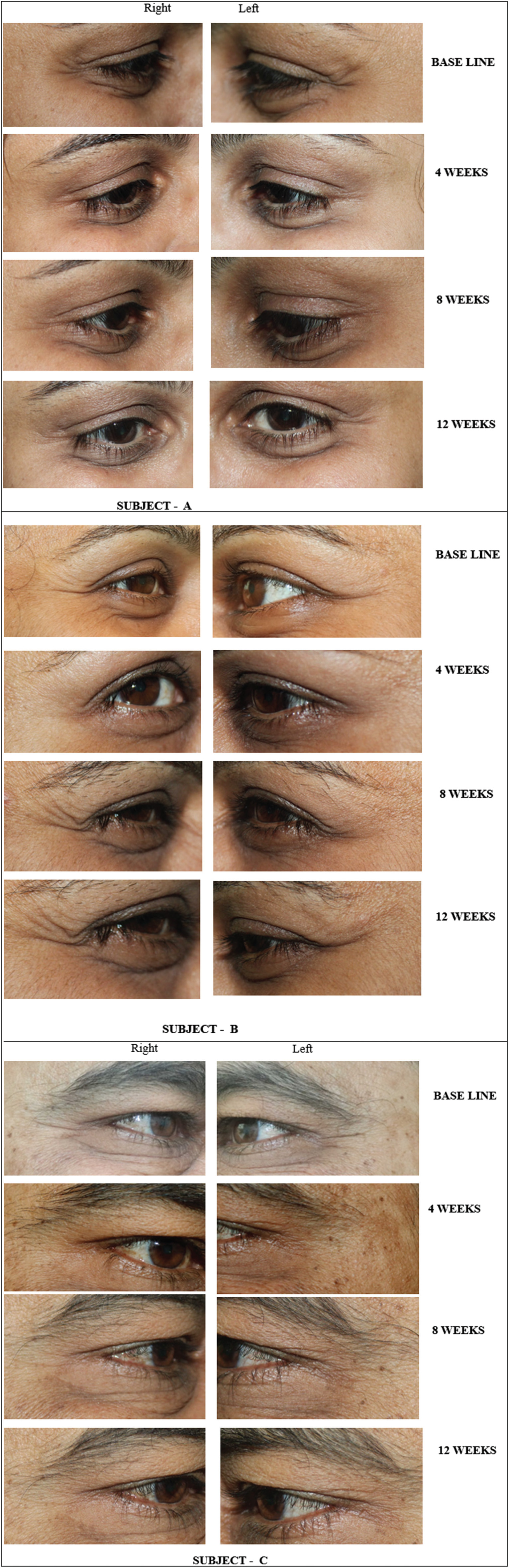 (A) Photograph showing lateral periorbital wrinkles at baseline, 4, 8, and 12 weeks. (B) Photograph showing lateral periorbital wrinkles at baseline, 4, 8, and 12 weeks. (C) Photograph showing lateral periorbital wrinkles at baseline, 4, 8, and 12 weeks